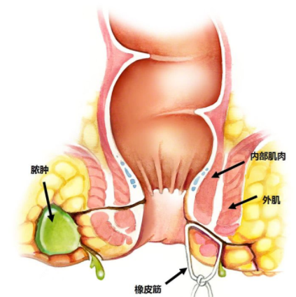 肛瘺非手術治療才可以嗎？手術是治療的關鍵途徑