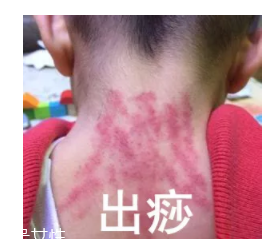 吮痧有什么療效？最溫柔的治病方法