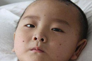 痣什么情況下會(huì)轉(zhuǎn)變?yōu)榱?？點(diǎn)痣不可取