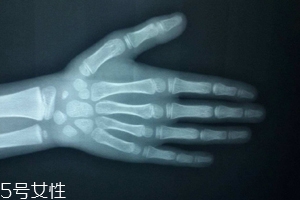哪些人需要測骨齡？長太快警惕骨齡提前