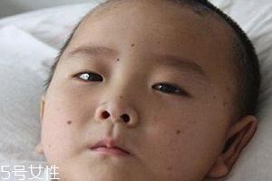 痣什么情況下會轉(zhuǎn)變?yōu)榱觯奎c痣不可取