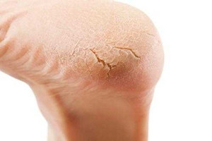 冬天裂腳怎么辦？5招緩解裂腳
