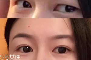 內(nèi)雙怎么進(jìn)化成雙眼皮？全是雙眼皮貼的功勞