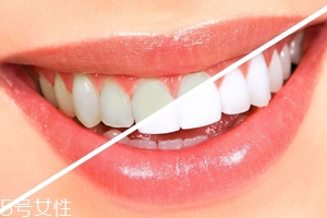 牙齒發(fā)黃是天生的嗎？只是你刷牙偷懶了