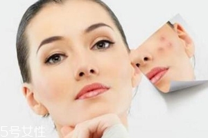 痘印多久能自行消失？多數(shù)人一年內消失