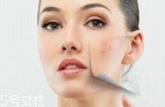 痘印多久能自行消失？多數(shù)人一年內消失
