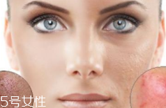 痘印多久能自行消失？多數(shù)人一年內消失