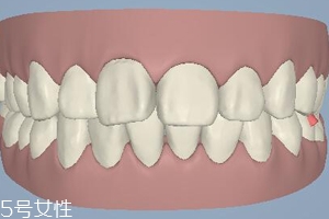 磨牙有哪些癥狀？牙齒變形甚至脫落