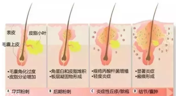 封閉性粉刺的發(fā)病機(jī)制是什么？角質(zhì)層太厚