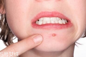 肌膚需要排毒嗎？長痘并不代表排毒