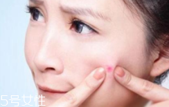 肌膚需要排毒嗎？長痘并不代表排毒