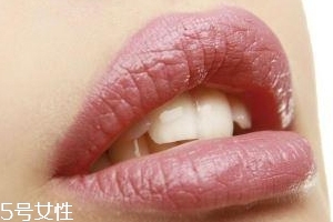 冬天爛嘴角什么原因？有可能營(yíng)養(yǎng)不良