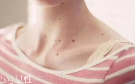 色素痣是腫瘤嗎？良性腫瘤不必擔心