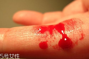 血友病的主要表現(xiàn)有哪些？出血是最明顯的特征