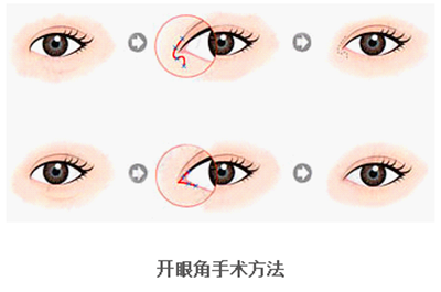 開眼角疤痕多久消失？開眼角的適宜人群