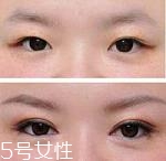 開眼角疤痕多久消失？開眼角的適宜人群
