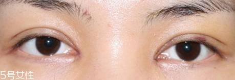 怎么縮短開眼角疤痕消失時間？雙眼皮開眼角恢復(fù)過程