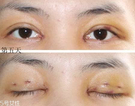 怎么縮短開眼角疤痕消失時間？雙眼皮開眼角恢復(fù)過程