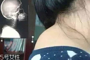 富貴包是什么病？姿態(tài)優(yōu)美少犯病