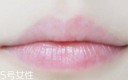 嘴唇干裂是一種病嗎？治療口角炎從改善習(xí)慣入手