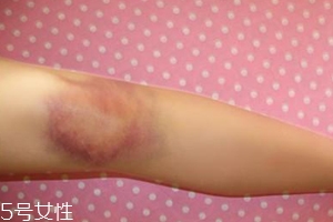 身體淤青怎么來(lái)的？不是磕碰那么簡(jiǎn)單