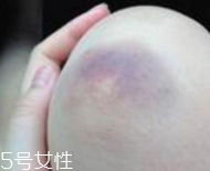 身體淤青怎么來(lái)的？不是磕碰那么簡(jiǎn)單