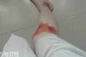摔傷了涂什么藥好的快？做好消毒才能愈合快