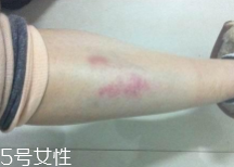 摔傷了涂什么藥好的快？做好消毒才能愈合快