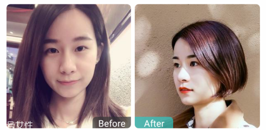 下瞼整形多久能恢復(fù)自然？半年時間