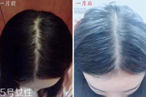 柳屋生發(fā)水有用嗎？一個月后長出新發(fā)