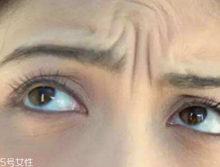 川字紋可以手術(shù)去除嗎？選擇手術(shù)需謹(jǐn)慎
