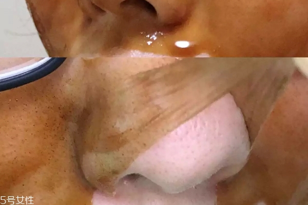 雪花秀撕拉面膜怎么撕出黑頭？這么做才能去黑頭