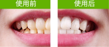 牙貼怎么分上下牙貼？牙貼怎么分正反