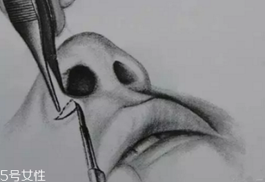 鼻翼外切多久消腫？鼻翼外切消腫時間要多長？