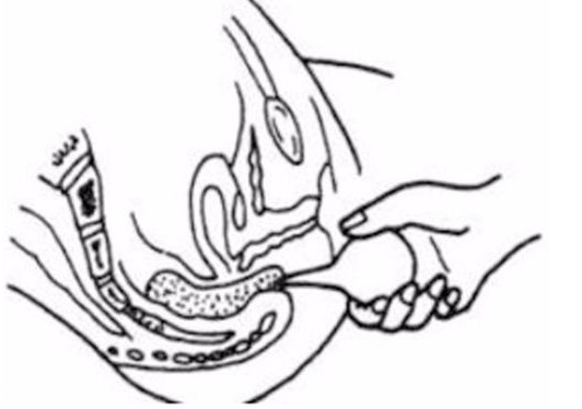 開塞露躺著還是蹲著用？開塞露使用姿勢