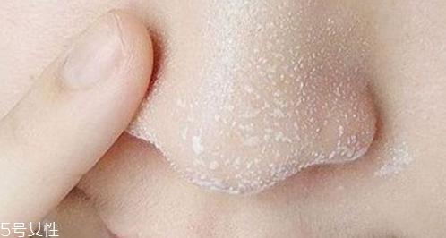 黑頭不管它會變大嗎？黑頭不管它會怎樣？