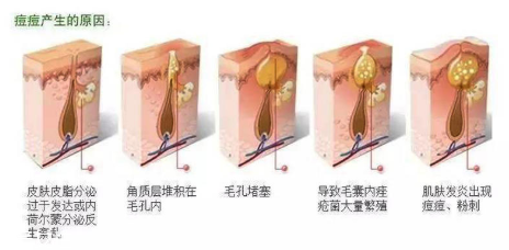 頑固痘痘怎么消除？油皮為什么反復(fù)爆痘？