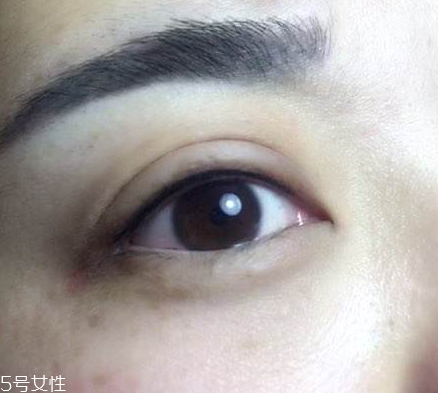 美瞳線(xiàn)會(huì)腫幾天 不超過(guò)一周