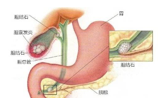 膽結(jié)石的食療方法 如何預防膽結(jié)石