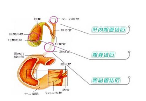 膽結(jié)石的食療方法 如何預防膽結(jié)石