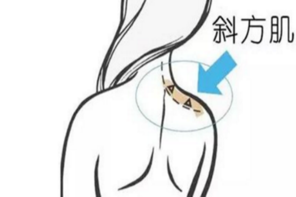 瘦肩針打哪個(gè)部位 主要針對斜方肌