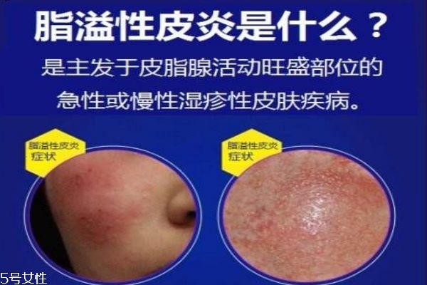 脂溢性皮炎癥狀 怎么預防