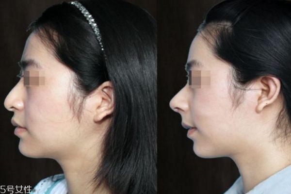 達拉斯隆鼻和普通隆鼻有什么區(qū)別 達拉斯隆鼻前后圖
