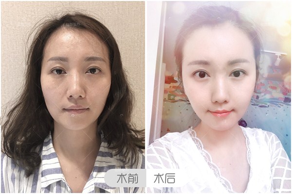 豐蘋果肌后怎么護(hù)理 豐蘋果肌的注意事項有哪些