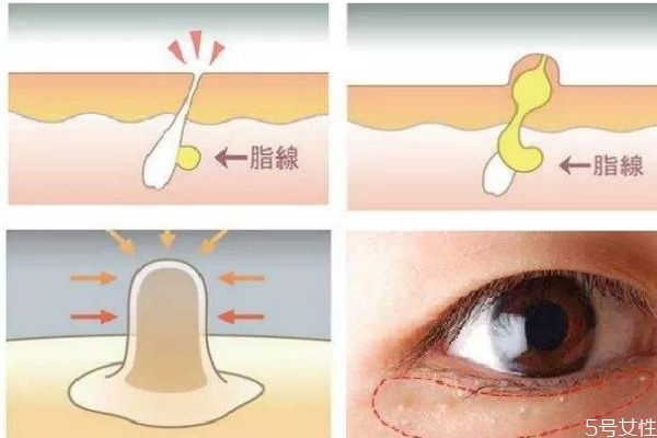 脂肪粒是怎么形成的呢 脂肪?？梢宰约汉脝?></p><h3</div>
<p class=