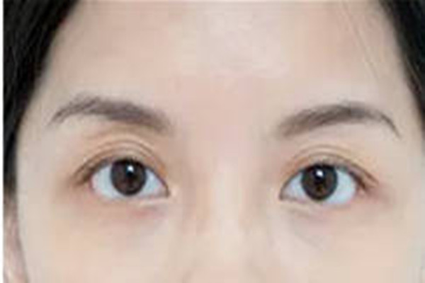 韓式去眼袋第二天會腫嗎 韓式去眼袋的注意事項