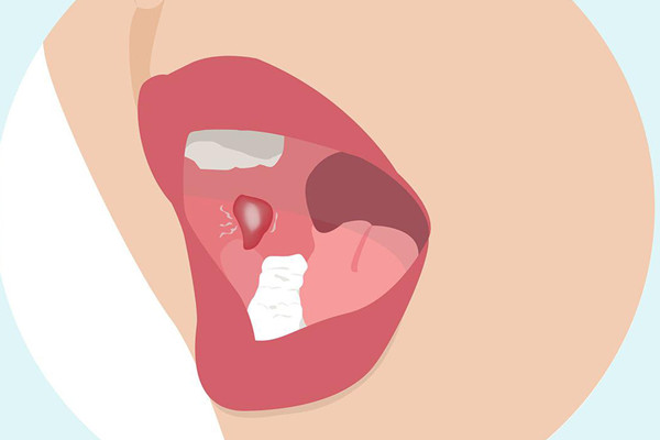 口腔潰瘍會導(dǎo)致臉腫嗎 口腔潰瘍會導(dǎo)致喉嚨痛嗎