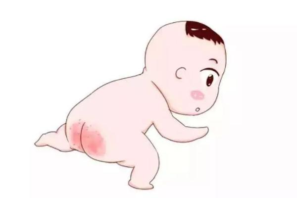 寶寶紅屁股怎么護(hù)理 寶寶紅屁股什么原因?qū)е?>
<p class=
