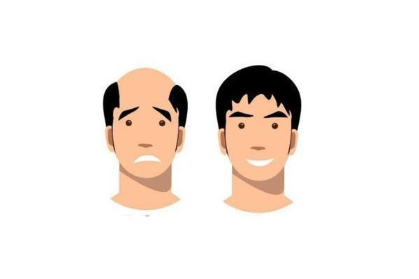 植發(fā)會(huì)不會(huì)再次脫落 植發(fā)用的是自己的頭發(fā)嗎