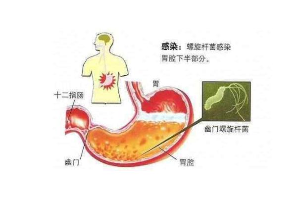 幽門(mén)螺桿菌要空腹查嗎 幽門(mén)螺桿菌要注意什么